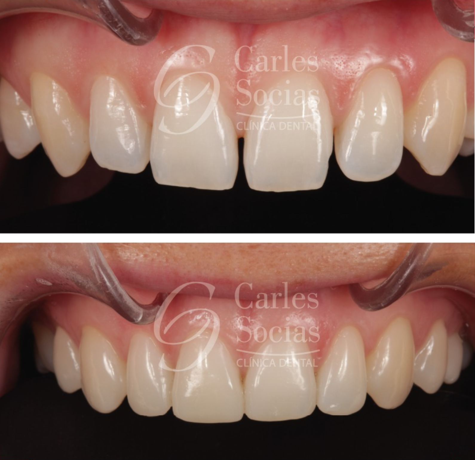 Carillas Dentales