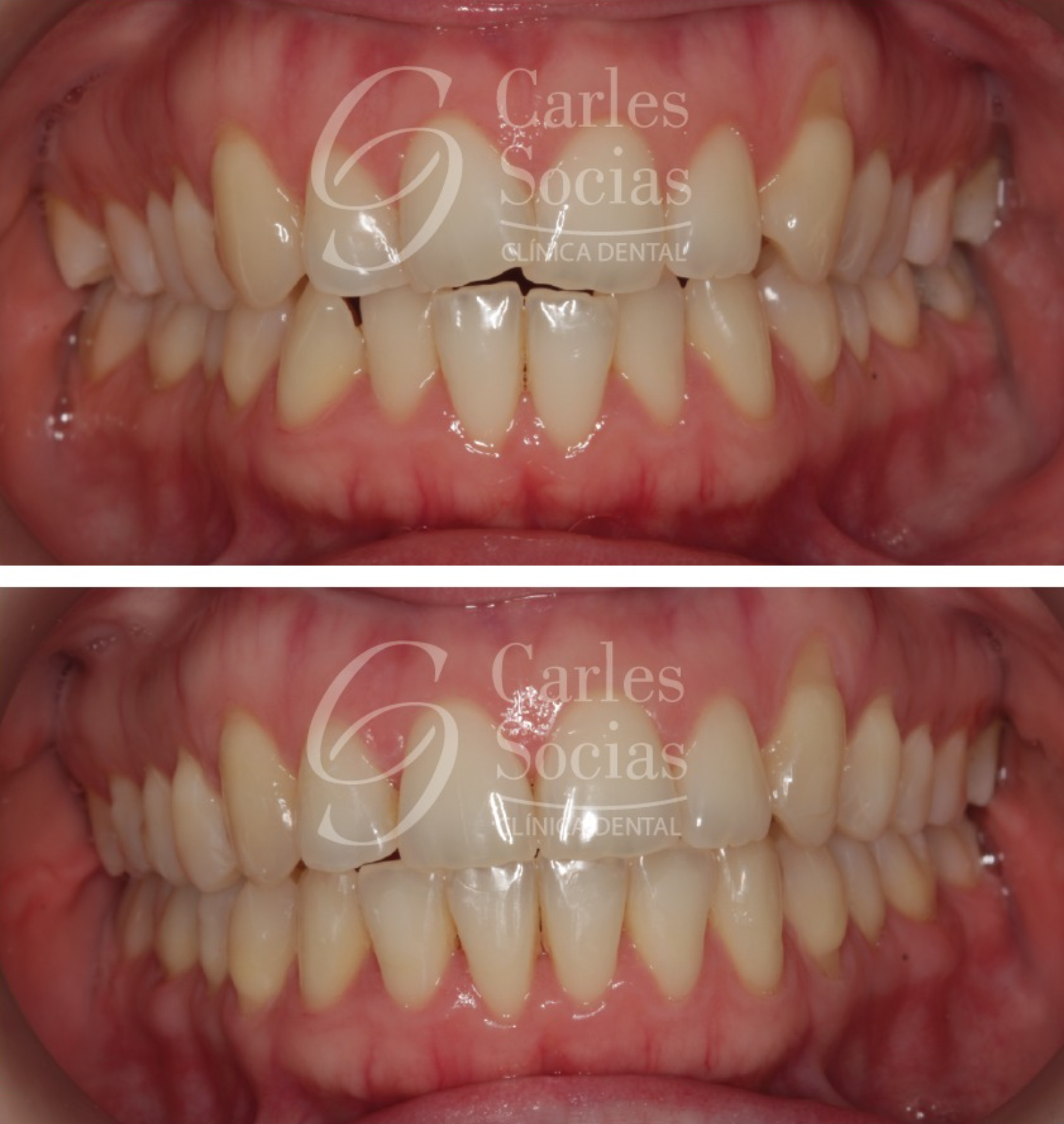 Ortodoncia Invisible