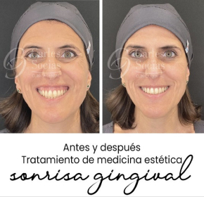 Sonrisa gingival
